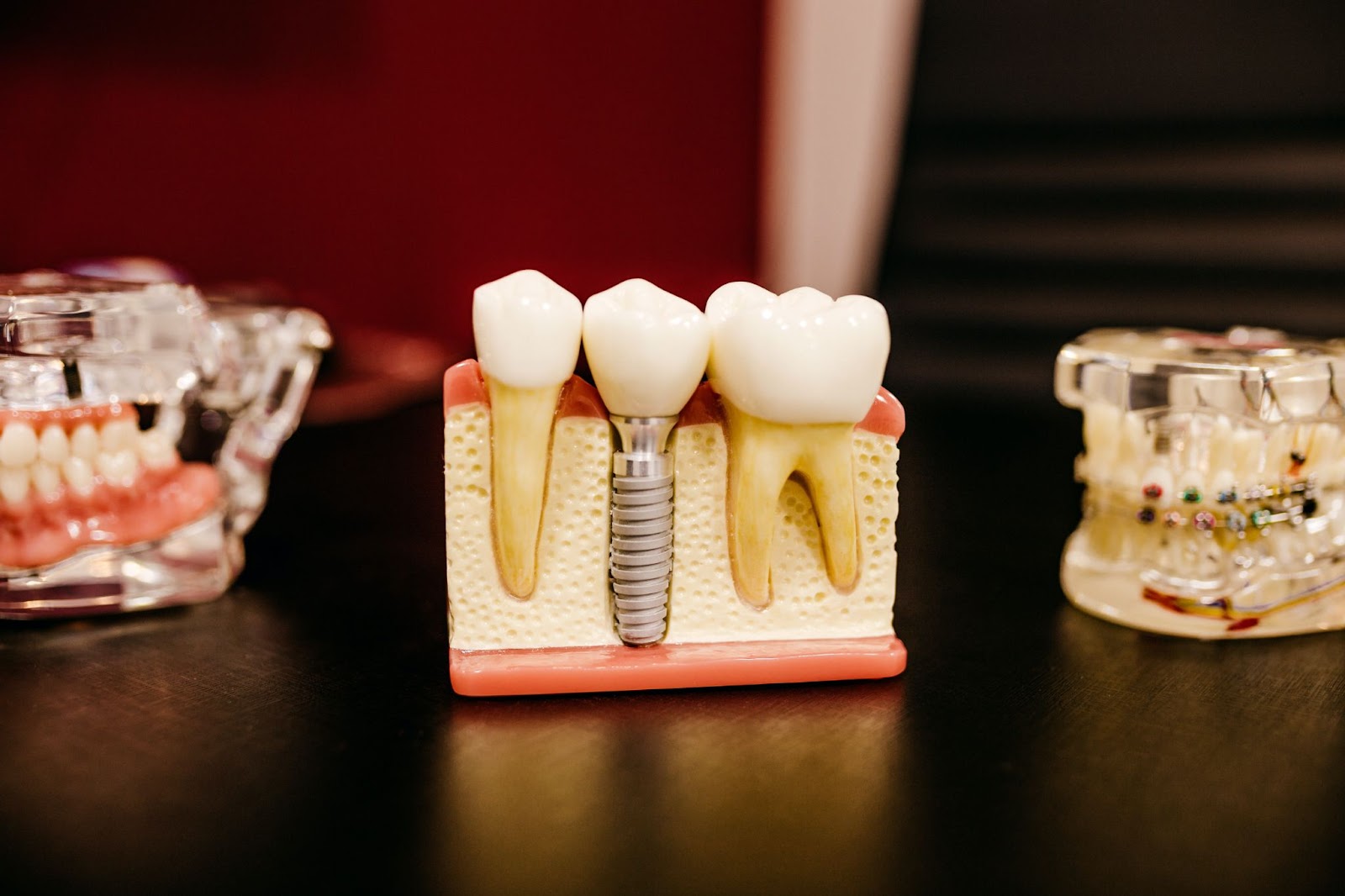 Dental Root Canal Treatment Who and What is Involved