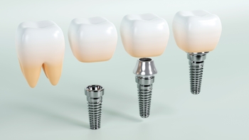 dental implant overseas wentworth point