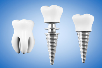 teeth implant in bali wentworth point