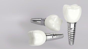 tooth implant in bali wentworth point